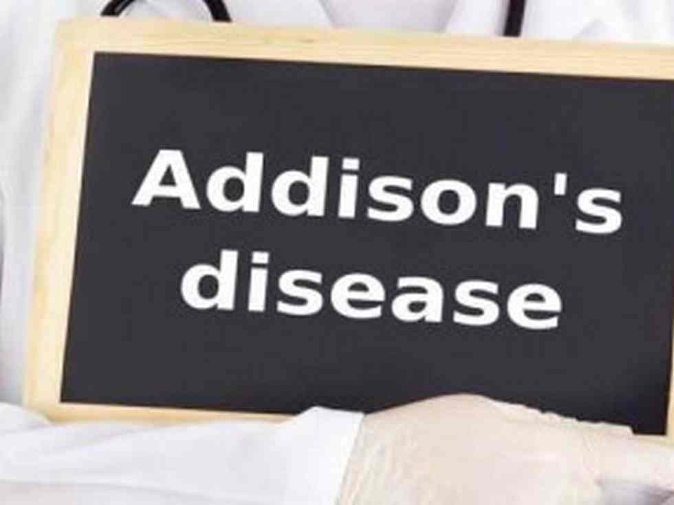  Weight reduction, fatigue +3 indicators and signs of Addison’s illness