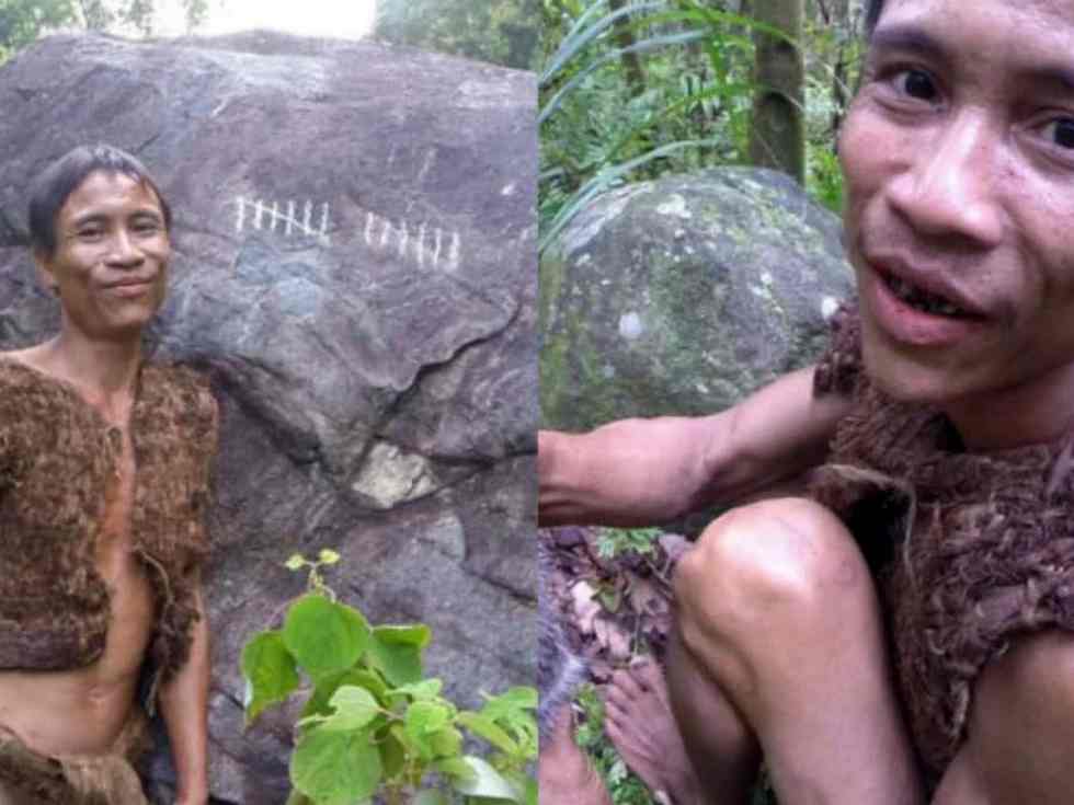  ‘Actual Life Tarzan’ Succumbs To Liver Most cancers After 41 Years of Jungle Life: How Unhealthy Weight-reduction plan Can Harm Your Liver