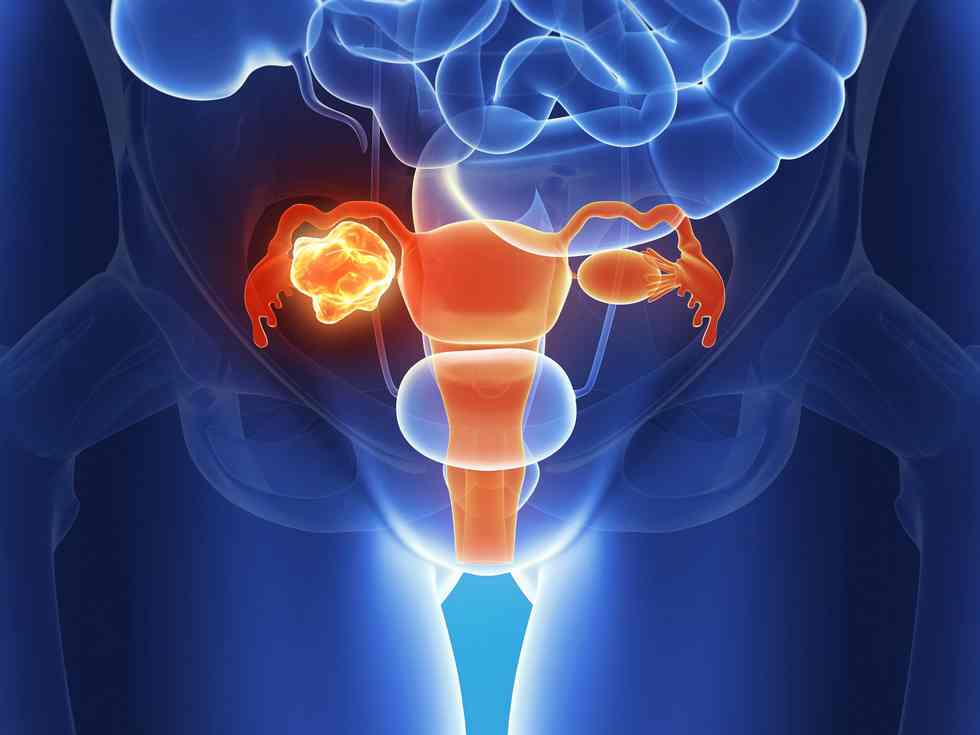  Right here’s Why Ovarian Most cancers Is So Arduous to Diagnose, In response to a Physician