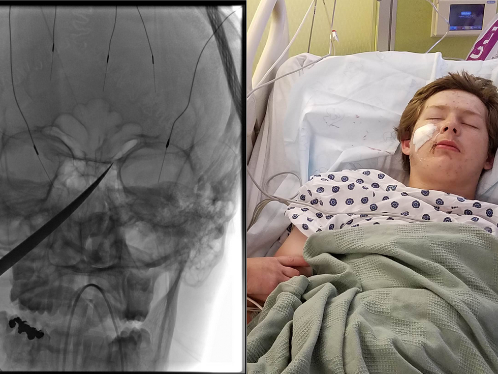  15-Yr-Previous Boy Miraculously Survives After 10-Inch Knife Impales His Face