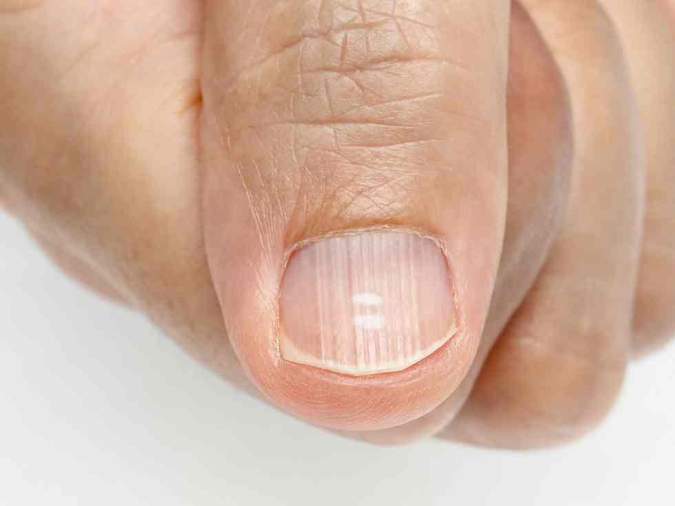  12 Methods to Get Rid of Ridges In Your Fingernails, In accordance with Dermatologists